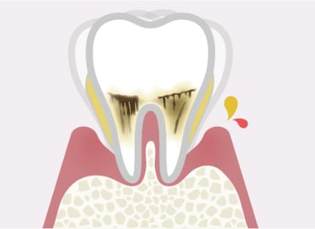 重等歯周炎